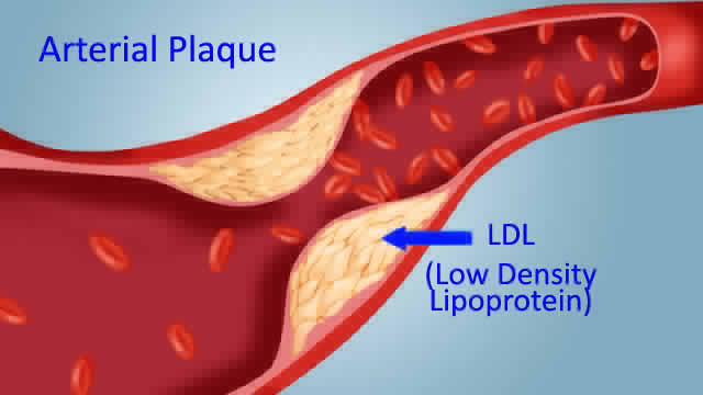 kolesterol boleh menyebabkan saluran darah tersumbat